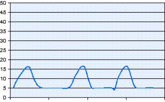 Which mode of ventilation is shown in the pressure-time scalar in the figure?   A)  Pressure-Controlled Continuous Mandatory Ventilation (PC-CMV)  B)  Volume-Controlled Continuous Mandatory Ventilation (VC-CMV)  C)  Pressure-Controlled Synchronized Intermittent Mandatory Ventilation (PC-SIMV)  D)  Volume-Controlled Synchronized Intermittent Mandatory Ventilation (VC-SIMV) 