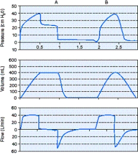 What is the trigger variable for the  A  breath shown in the figure below?   A)  Flow B)  Time C)  Pressure D)  Volume