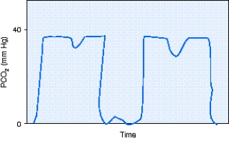 During shift report,the day shift respiratory therapist informs the night shift respiratory therapist about a freshly postoperative patient who is receiving full support via mechanical ventilation.At the time of the last patient-ventilator system check the patient had not awaken from anesthesia.During first rounds on the day shift the respiratory therapist notes the capnography shown in the figure.The most appropriate action to take would be to do which of the following?   A)  Administer a bronchodilator. B)  Begin the weaning process. C)  Fix the leak in the sampling line. D)  Reinflate the ET tube cuff.