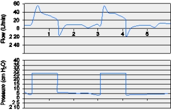 A patient with asthma is being ventilated in PSV,5 cm H<sub>2</sub>O,with CPAP of 5 cm H<sub>2</sub>O.The patient has chest wall retractions on most breaths and appears to have an increased WOB.The following graphic occurred the entire time the respiratory therapist was assessing the patient.What does this graphic demonstrate?   A)  Trigger asynchrony B)  Mode asynchrony C)  PEEP asynchrony D)  Cycle asynchrony