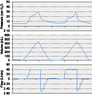 The graphics below indicate which of the following conditions?   A)  Auto PEEP B)  Active exhalation C)  Inadequate flow setting D)  Increased expiratory resistance