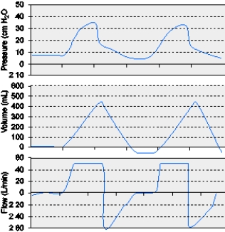 The graphic below for a patient receiving mechanical ventilation shows which of the following conditions?   A)  Leak in the circuit B)  Active inspiration C)  Active exhalation D)  Intrinsic PEEP