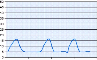 Which mode of ventilation is shown in the pressure-time scalar in the figure?   A)  Pressure-controlled continuous mandatory ventilation (PC-CMV)  B)  Volume-controlled continuous mandatory ventilation (VC-CMV)  C)  Pressure-controlled intermittent mandatory ventilation (PC-IMV)  D)  Volume-controlled intermittent mandatory ventilation (VC-IMV) 
