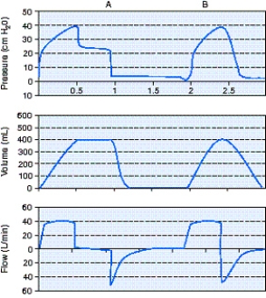Calculate the static compliance using the information from the scalar below.   A)  10 mL/cm H₂O B)  16 mL/cm H₂O C)  20 mL/cm H₂O D)  80 mL/cm H₂O