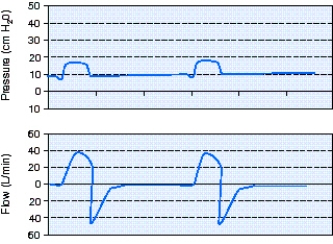 What is the flow-cycle setting for the pressure support ventilation (PSV) breaths shown in the scalars below?   A)  10% B)  25% C)  40% D)  50%