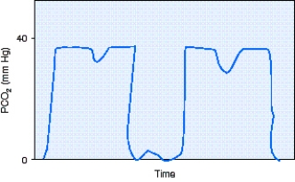 During shift report,the day shift respiratory therapist informs the night shift respiratory therapist about a freshly postoperative patient who is receiving full support via mechanical ventilation.At the time of the last patient-ventilator system check the patient had not awaken from anesthesia.During first round on the day shift the respiratory therapist notes the capnography shown in the figure.The most appropriate action to take would be to do which of the following?   A)  Administer a bronchodilator. B)  Begin the weaning process. C)  Fix the leak in the sampling line. D)  Reinflate the ET tube cuff.