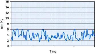 During the introduction of a pulmonary artery catheter the waveform seen in the figure is visible on the monitor.This waveform represents which of the following locations?   A)  Right atrium B)  Right ventricle C)  Pulmonary artery D)  Pulmonary capillary