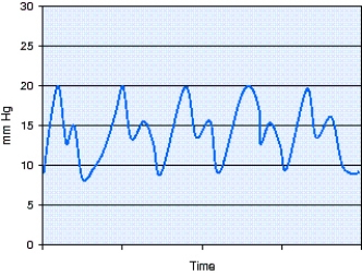 The waveform of a pulmonary catheter,shown in the figure,is located in which of the following?   A)  Right atrium B)  Pulmonary artery C)  Right ventricle D)  Pulmonary capillary with a wedge