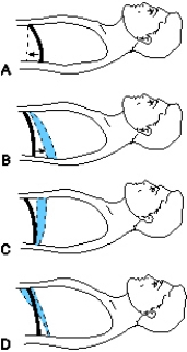 In a mechanically ventilated patient who is receiving lorazepam and succinylcholine,the diaphragm moves in which of the following ways?   A)  A B)  B C)  C D)  D