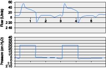A patient with asthma is being ventilated in PSV,5 cm H₂O,with CPAP of 5 cm H₂O.The patient has chest wall retractions on most breaths and appears to have an increased WOB.The following graphic occurred the entire time the respiratory therapist was assessing the patient.What does this graphic demonstrate?   A)  Trigger asynchrony B)  Mode asynchrony C)  PEEP asynchrony D)  Cycle asynchrony