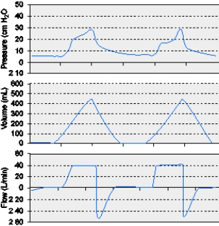 The graphics below indicate which of the following conditions?   A)  Auto-PEEP B)  Active exhalation C)  Inadequate flow setting D)  Increased expiratory resistance