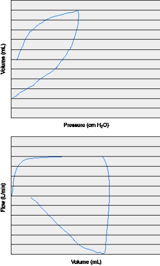 The following two graphic loops show which of the following conditions?   A)  Leak in the patient-ventilator circuit B)  Increased airway resistance C)  Decreased lung compliance D)  Active exhalation