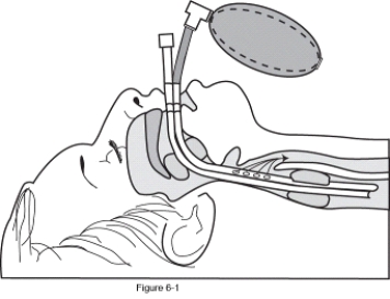 The following diagram represents which artificial airways?   A)  Combitube B)  Endotrol tube C)  Guedel airway D)  Laryngeal mask airway
