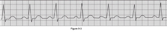 What is the heart rate shown on the following ECG?   A)  60 B)  78 C)  90 D)  100