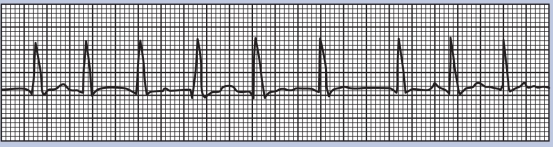 What is the cardiac rhythm depicted on the following electrocardiogram?   A)  Atrial fibrillation B)  Premature atrial beats C)  Paroxysmal atrial tachycardia D)  Premature ventricular contractions