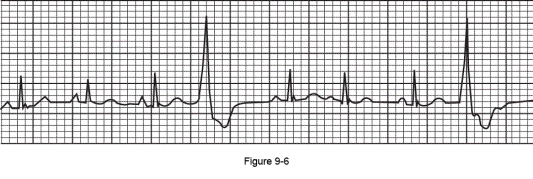 What is the name of the following cardiac arrhythmia?   A)  Paroxysmal atrial tachycardia B)  Atrial premature depolarization C)  Premature ventricular contractions D)  Wolff-Parkinson-White syndrome