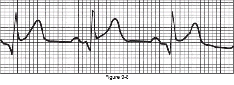 The aVL lead shows the electrocardiogram in the below figure.This is indicative of the occlusion of which of the following coronary arteries?   A)  Left coronary artery B)  Circumflex artery C)  Right coronary artery D)  Anterior interventricular branch of the left coronary artery