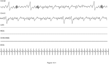 Which stage(s) of sleep is (are) shown in the figure?   A)  Stage 1 sleep B)  Stage 2 sleep C)  Stages 3 and 4 sleep D)  Rem sleep