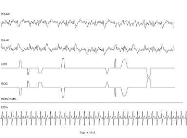 Which stage(s) of sleep is (are) shown in the figure?   A)  Stage 1 sleep B)  Stage 2 sleep C)  Stages 3 and 4 sleep D)  Rem sleep