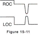 <strong>Electrooculogram electrodes are in place,and the eyes are looking up.The electrooculogram recording is shown by which of the following?</strong> A)   B)   C)   D)   <div style=padding-top: 35px> 