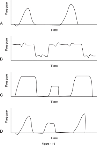 In the figure,the pressure-time curve that represents pressure-controlled intermittent mandatory ventilation plus pressure support is which of the following?   A)  A B)  B C)  C D)  D