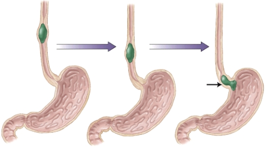 What might occur if the sphincter denoted here doesn't close correctly, and some of the contents from the stomach enter into the esophagus?   A)  Choking B)  Constipation C)  Heartburn D)  Peptic ulcers