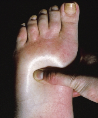 What is the condition called that is depicted in this photograph?   SPL/Photo Researchers, Inc. A)  marasmus B)  edema C)  osmosis D)  myosin