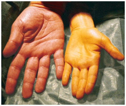 This visual represents a toxicity of ______ leading the toxicity disease _______.   A)  beta-carotene, hypercarotenemia B)  niacin, pellagra C)  vitamin A, xerophthalmia D)  vitamin D, rickets
