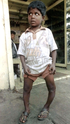 Vitamin D deficiency can result in bone deformation in children, as illustrated in this picture. What is the name of the vitamin D deficiency when it occurs in children? What are the physical characteristics? What is the name of the vitamin D deficiency when it occurs in adults? What are the physical characteristics? Why are the physical characteristics different for children as compared to adults?   