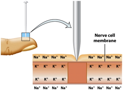 As illustrated in this picture, you feel a pinprick because it stimulates nerves under the skin. Describe the roles that sodium and potassium play in nerve impulse transmission. In your response, make sure to address the following: How are electrolyte concentrations of sodium and potassium disrupted? How does the nerve impulse travel through the nerve to signal the brain? How are electrolyte concentrations restored?   