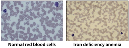 The pictures that you see here are of normal red blood cells and red blood cells when someone has iron deficiency anemia. Describe the differences between the cells. Why does too little iron cause the red blood cells to change?   