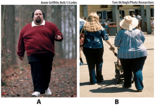 Based on their distribution of body fat, which of the persons is at increased risk for type 2 diabetes?   A)  Picture A B)  Picture B
