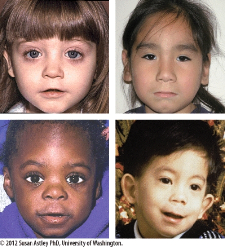 This is a photo of young children who have fetal alcohol syndrome. What are the characteristics of a child who has fetal alcohol syndrome? How does this differ from alcohol-related neuro-developmental disorders? Why does alcohol consumption during pregnancy cause these conditions?   