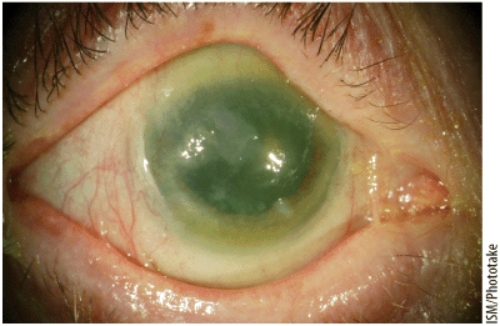 Xerophthalmia, as shown in this visual, is a leading cause of preventable blindness due to a deficiency of   A)  calcium. B)  iodine. C)  iron. D)  vitamin A.