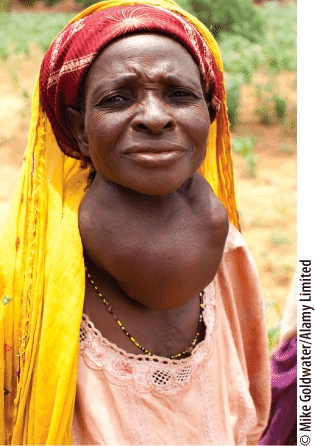Goiter, as seen here, is a caused by an _____ deficiency.   A)  calcium B)  iodine C)  iron D)  vitamin A