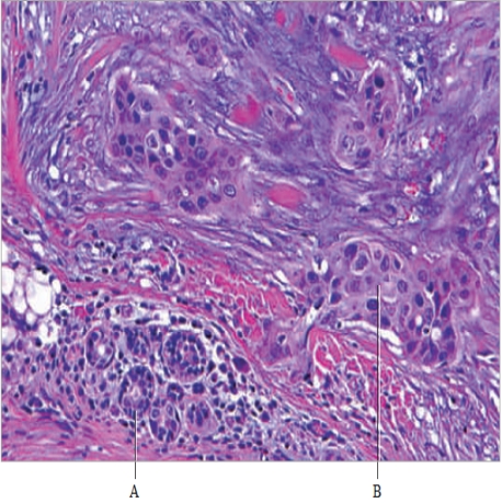 Figure 10.1    -When cells stop responding to normal controls over growth and division they A)  ​begin to form a tumor. B)  ​produce a malignancy. C)  ​start to die. D)  ​kill surrounding cells. E)  ​produce scar tissue. 