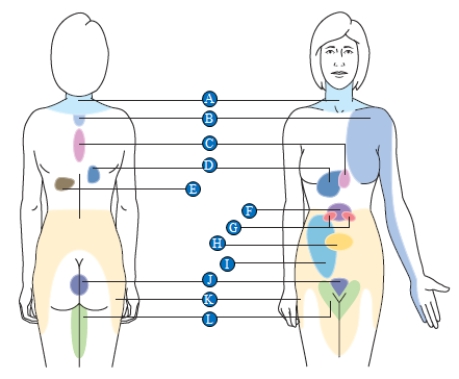 Figure 33.6​    -The accompanying figure shows areas of referred pain that indicate an internal organ is damaged. Which letter corresponds to heart damage?​ A)  ​A B)  ​B C)  ​C D)  ​D E)  ​E 