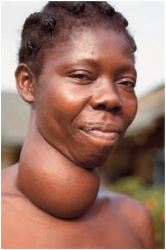 Figure 34.10    -The woman in the above photograph has been afflicted by ____. A)  ​low iodine in the diet B)  ​hypothyroidism C)  ​vitamin D deficiency D)  ​testosterone excess E)  ​progesterone deficiency 