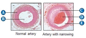 ​     Use the figure above to answer the following question. -The anatomical structure identified with the letters  B  and  E  in the figure above is the ____. A)  ​arterial wall B)  ​lumen C)  ​venous wall D)  ​capillary wall E)  connective tissue​ 