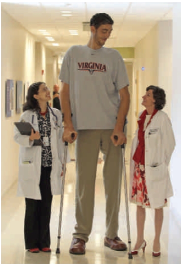 Figure 34.5    -What is the most likely cause of the excessive growth exhibited by the person in the center of the accompanying figure?   A)  Pituitary tumor B)  Lack of GH receptor response C)  Low levels of rhGH D)  Cretinism E)  Laron syndrome