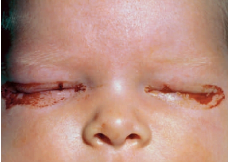 Figure 41.13A    -The disease acquired from the mother during childbirth shown in the above infant photograph is caused by ____.   A)  syphilis B)  gonorrhea C)  chlamydia D)  HPV E)  AIDS