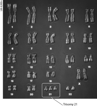 <strong>The karyotype below shows ______. </strong> A) abnormal sex chromosomes B) trisomy 21, a cause of Klinefelter syndrome C) Turner syndrome D) trisomy 21, a cause of Down syndrome