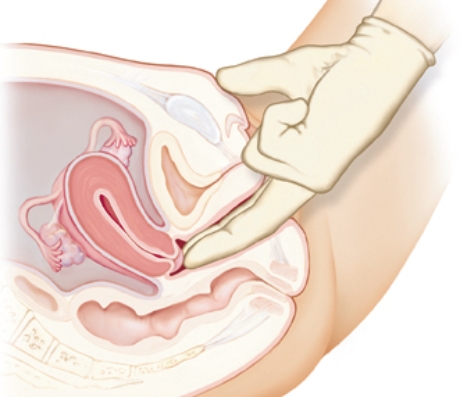 The healthcare provider is performing an assessment on a pregnant client.The examiner notes a softening in the area being assessed.Review the photograph below and identify the probable sign of pregnancy being assessed.   A) Goodell's sign B) Hegar's sign C) Chadwick's sign D) Ladin's sign 