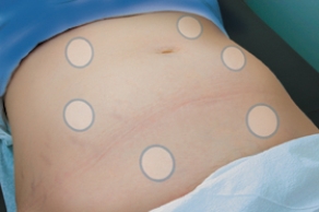 The nurse is preparing to assess the fetal heart tones for a client whose fetus is in the LOA position.Review the photograph below and draw an  X  to indicate the best location to assess for the heart tones.  