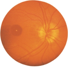 The nurse is assessing the client's retina.Draw an arrow pointing toward the location of the optic disc.