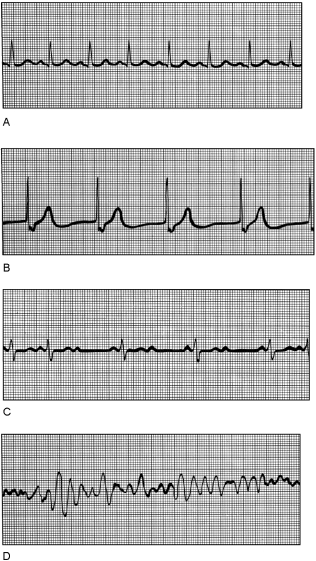   Figure 18.3Using Figure 18.3, match the following: -The ECG wave interval represents ventricular repolarization.
