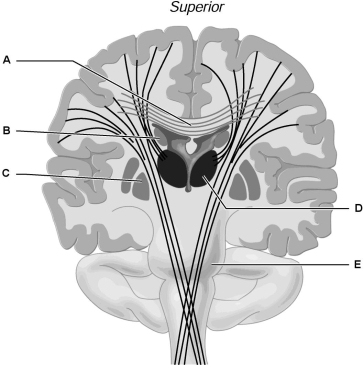   Figure 12.2Using Figure 12.2, match the following: -A temporary cessation of breathing during sleep found most commonly in the elderly is called sleep .