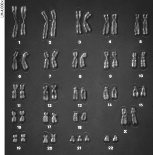 <strong>  The karyotype above shows ________.</strong> A) abnormal sex chromosomes B) trisomy 21, a cause of Klinefelter syndrome C) Turner syndrome D) trisomy 21, a cause of Down syndrome <div style=padding-top: 35px> 