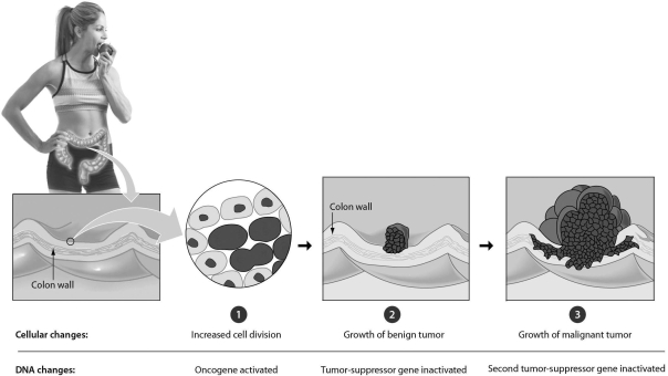 <strong>Examine the figure below.In a typical colon cancer,the first step is ________.  </strong> A) the inactivation of a tumor-suppressor gene B) the mutation of a tumor-suppressor gene, producing an oncogene C) the mutation of a proto-oncogene, producing an oncogene D) the conversion of an oncogene to a tumor-suppressor gene <div style=padding-top: 35px> 