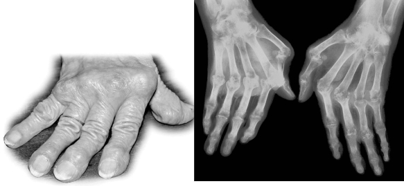 Examine the photograph of the hand in the following figure.The person's joints are severely damaged because ________.   A)  the immune system has damaged the cartilage and bone of the joints B)  a viral infection has attacked the cartilage of the fingers C)  cytotoxic T cells have destroyed the bone in the fingers D)  T cells have reacted against the myelin in the hand